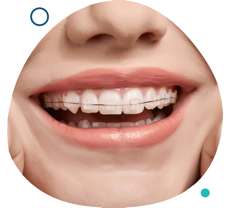 Ceramic Braces