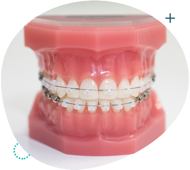 Self Ligating Braces