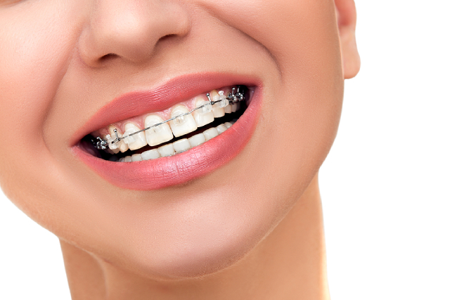 Why Are Damon Clear Braces Becoming A Trend? Why Are Damon Clear Braces Becoming A Trend?
