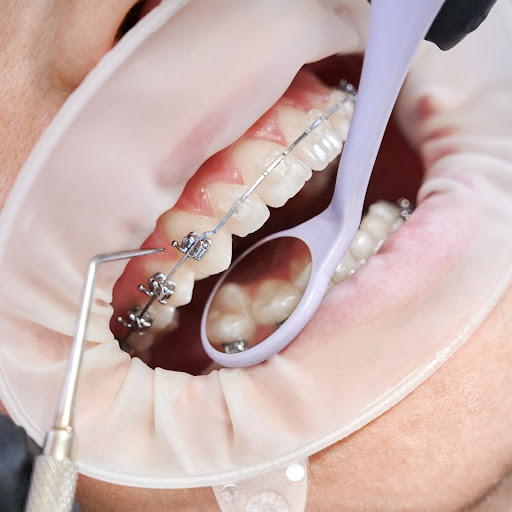 applying a new set of braces