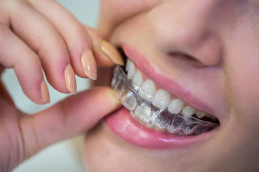 clear aligner for teeth