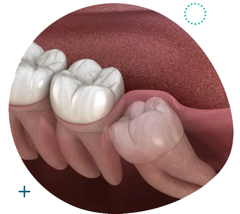 Wisdom Tooth Surgery