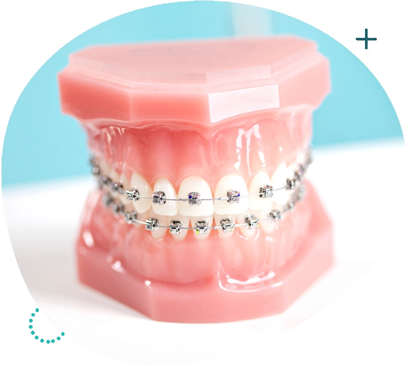 Student Braces Singapore