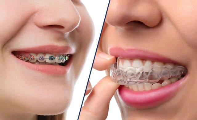 Living With Braces or Invisalign