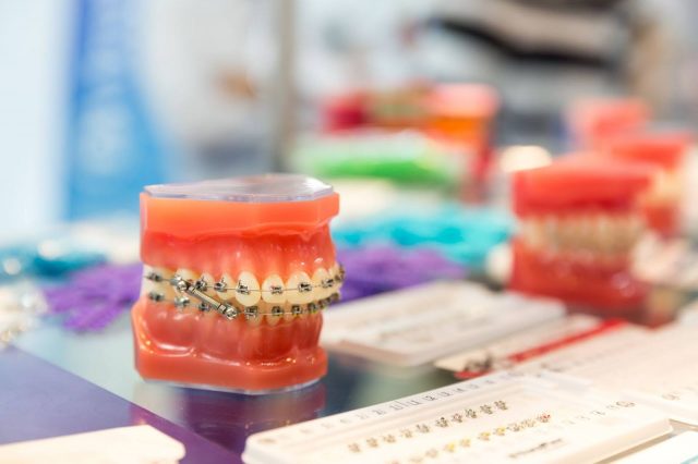is lingual braces right for you