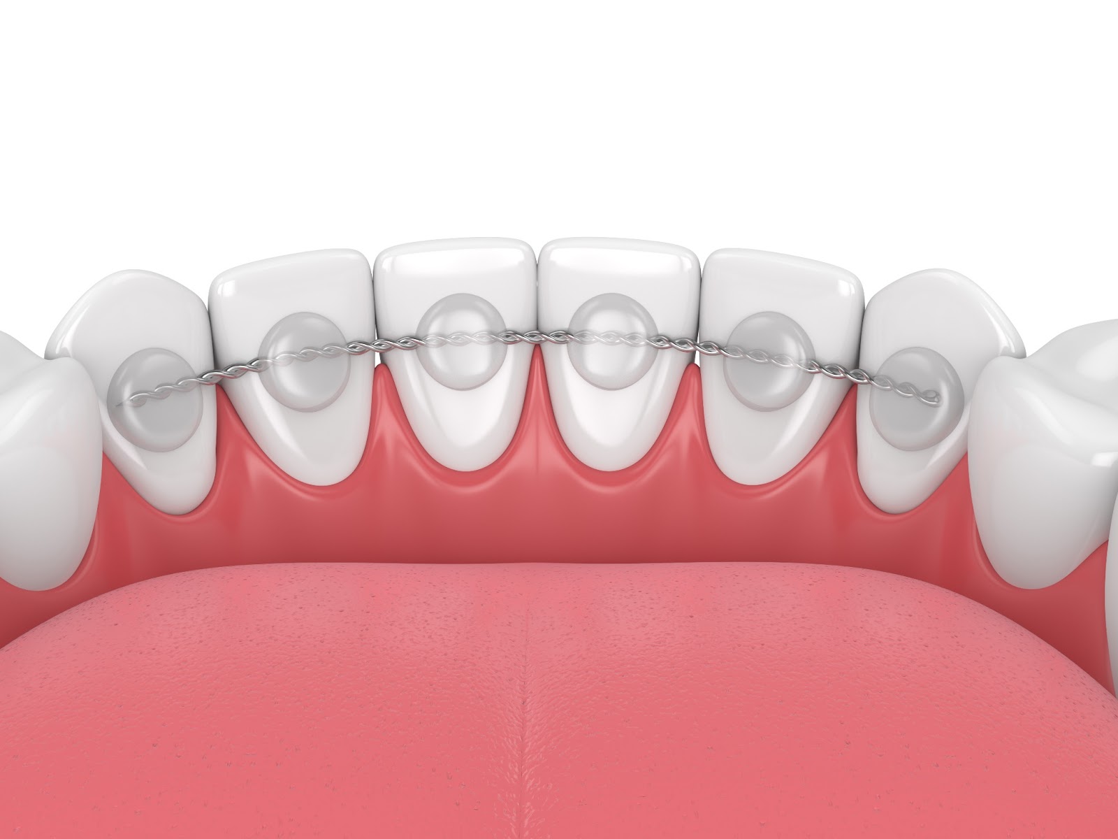 fit in braces practice