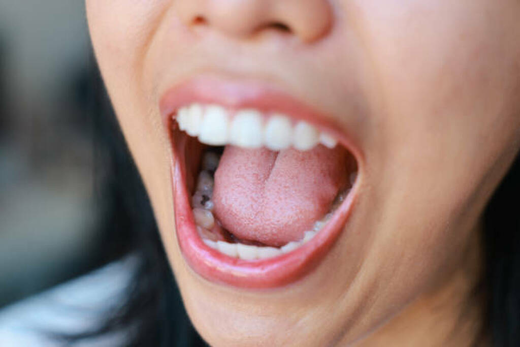 Can You Get Braces If You Have Cavities?